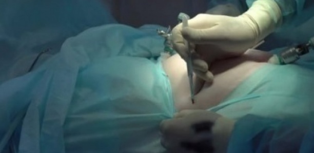 Brésil : Les médecins découvrent un fœtus calcifié depuis 30 ans, dans le ventre d’une vieille dame