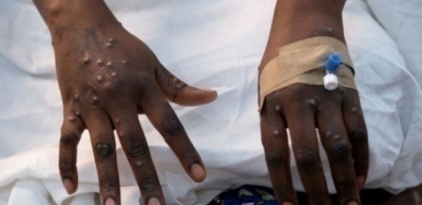 Mpox: l'OMS maintient son plus haut niveau d'alerte