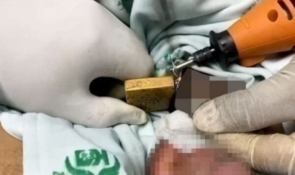 Thaïlande : Le Pénis D’un Homme Coincé Dans Un Cadenas Pendant Deux Semaines