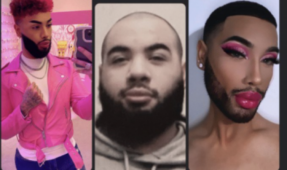 Un Fan De Nicki Minaj Dépense Près De 50 000 Dollars En Chirurgie Plastique Pour Lui Ressembler